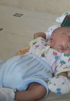 Indonesia: Bé trai mắc dị tật hiếm gặp với 2 khuôn mặt và 2 bộ não