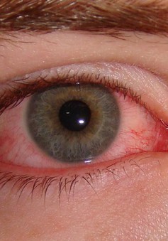 Phòng bệnh đau mắt đỏ mùa mưa lũ
