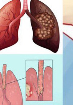 Bạn có mắc triệu chứng này của ung thư phổi?