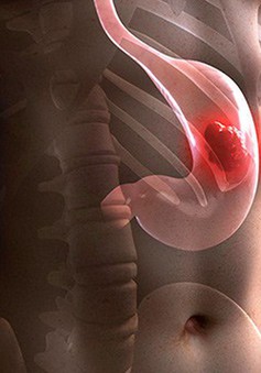 Hồng sâm và tác dụng tăng cường miễn dịch ở bệnh nhân phẫu thuật ung thư dạ dày