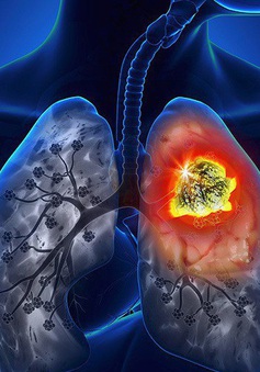Phát hiện khối u ác tính ở phổi sau thời gian dài bị ho