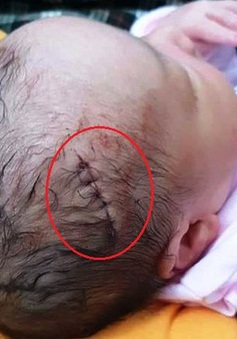 Bé sơ sinh bị dao cắt rách da đầu