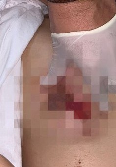 "Nâng cấp" ngực sau sinh con, một phụ nữ ở Hà Nội bị biến chứng nhập viện