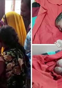 Bé gái sơ sinh... “ba đầu” tại Ấn Độ