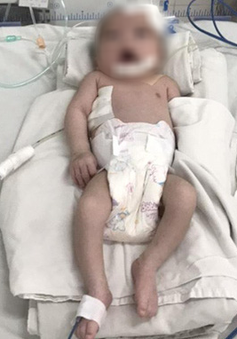 Bé gái sơ sinh bị teo thực quản hiếm gặp kèm biến chứng viêm phổi