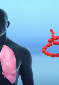 Bệnh viêm phổi do chủng virus mới diễn biến phức tạp