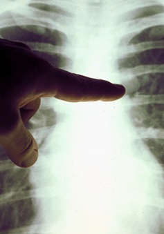 Ung thư phổi có thể bị chẩn đoán nhầm thành COVID-19