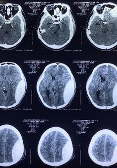 Tháo nắp sọ gửi ngân hàng mô, cứu bệnh nhân chấn thương sọ não