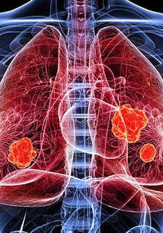Điều trị ung thư phổi bằng phương pháp ghép phân tử hóa trị