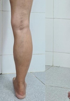 Xuất hiện các bớt ở chân, người phụ nữ không ngờ mắc bệnh nguy hiểm