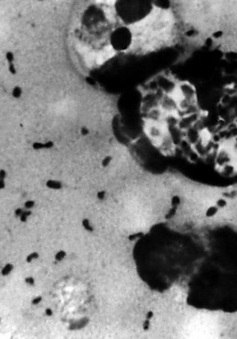 CHDC Congo xác nhận bệnh dịch hạch bùng phát, hàng chục người tử vong