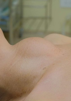 Bóc tách khối bướu giáp kích thước lớn cho 3 bệnh nhân nữ ở Tây Ninh