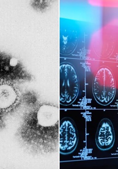Giới khoa học tìm cách lý giải di chứng "sương mù não" ở bệnh nhân COVID-19