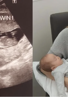 Hiếm gặp: Có bầu khi đang mang thai 3 tháng