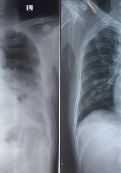Hậu COVID-19: Bệnh nhân bị áp xe phổi, tràn khí màng phổi