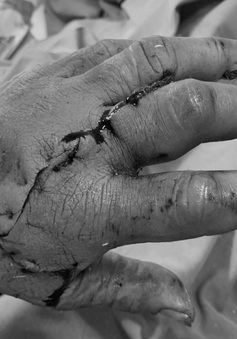 Nối lại ngón tay bị đứt lìa do tai nạn lao động cho nam bệnh nhân
