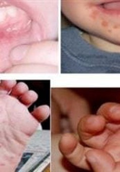 Trong 1 tuần, Đà Nẵng ghi nhận hơn 100 trẻ mắc tay chân miệng