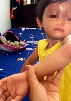 Vụ bé gái 4 tuổi ở Cà Mau bị đánh đập: Cha nuôi nhiều lần đánh con