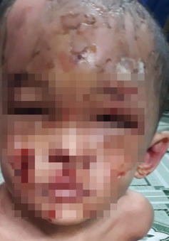 Bé trai 1 tuổi người đầy vết thương, vết bỏng, nghi bị cha mẹ bạo hành
