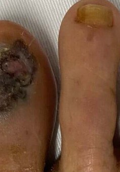Mắc ung thư tế bào hắc tố sau khi xuất hiện mảng đen ở ngón chân