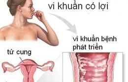 Viêm nhiễm phụ khoa và cách phòng tránh