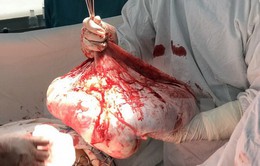 Phẫu thuật thành công khối u buồng trứng 35kg: Bệnh nhân tiếp tục được hóa trị