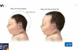 Florida (Mỹ) xác nhận sản phụ đầu tiên nhiễm Zika sinh con đầu nhỏ