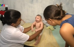 Liệu pháp xoa bóp điều trị trẻ em bị dị tật đầu nhỏ do Zika