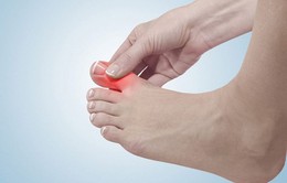 Mẹo nhỏ giảm đau nhanh nhất khi ngón chân cái bị sưng tấy