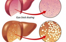 Biểu hiện của gan nhiễm mỡ qua từng giai đoạn
