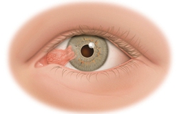 Bệnh mộng mắt và phương pháp điều trị