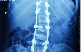 Kỹ thuật cắt V xương: cơ hội điều trị gù vẹo cột sống do thoái hóa