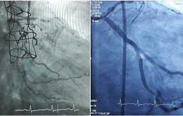 Đặt cùng lúc 3 stent cứu sống người phụ nữ khỏi tử thần