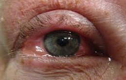 Các biến chứng ở mắt của bệnh đái tháo đường