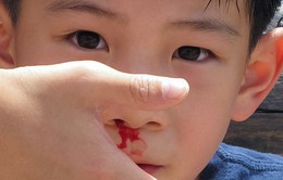 Khi trẻ chảy máu cam cần làm gì?