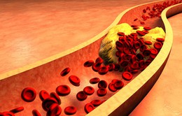Cholesterol xấu có thể không phải là thủ phạm gây bệnh tim mạch