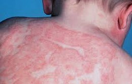 Lưu ý chăm sóc da cho trẻ bị viêm da cơ địa trong mùa hè