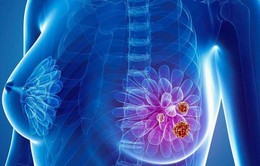 Các dấu hiệu tái phát di căn bệnh ung thư vú