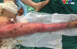 Sang Trung Quốc làm việc bé trai 12 tuổi bị tai nạn lóc da
