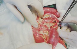Trẻ 36 tháng tuổi bị viêm phúc mạc do thủng ruột non