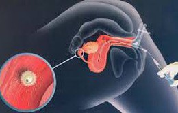 Bơm tinh trùng vào buồng tử cung: Kỹ thuật đầu tay trong điều trị vô sinh