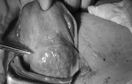 Cần Thơ: Phẫu thuật bảo tồn tử cung thành công cho thai phụ bị thai bám sẹo mổ cũ