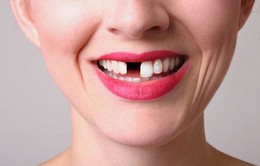 Răng vĩnh viễn mất rồi có mọc lại được không?