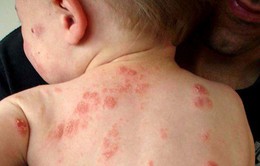Những bệnh về da thường gặp ở trẻ