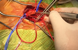 Phẫu thuật cho bệnh nhân bị hẹp động mạch cảnh