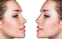 Những điều cần biết về phẫu thuật thẩm mỹ mũi
