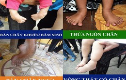 Phẫu thuật nhân đạo cho người dị tật bàn chân và cổ chân tại Quảng Ninh