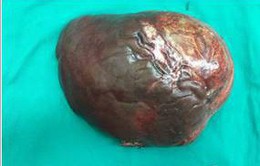 Ca bệnh hiếm: Khối u gan 5kg ở bệnh nhân u cơ mỡ mạch gan
