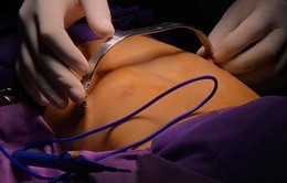 Phẫu thuật nội soi điều trị bệnh lý lõm ngực bẩm sinh ở trẻ