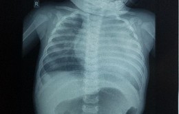 Phẫu thuật thành công bất thường động mạch vành xuất phát từ động mạch phổi